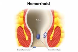 طب سوزنی برای درمان بواسیر (هموروئید) Acupuncture for the treatment of hemorrhoids