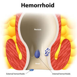 طب سوزنی برای درمان بواسیر (هموروئید) Acupuncture for the treatment of hemorrhoids