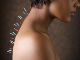 معجزه طب سوزنی Miracle Acupuncture