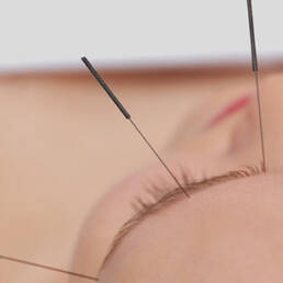 وقتی طب سوزنی مدرن می شود when acupuncture get modern