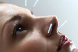 acupuncture for wrinkles