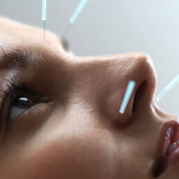 acupuncture for wrinkles