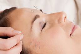 Acupuncture face lift