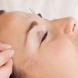 Acupuncture face lift